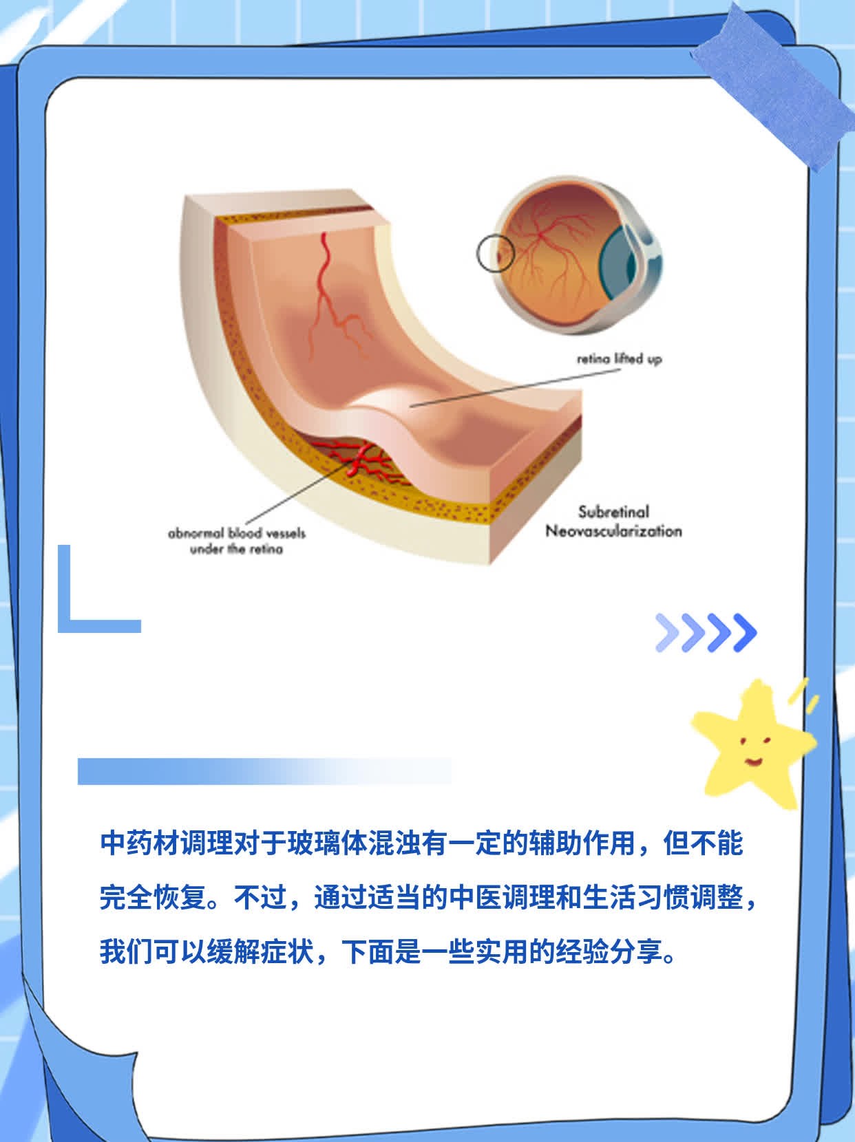 玻璃体混浊治疗新突破，特效药物与希望之光探索