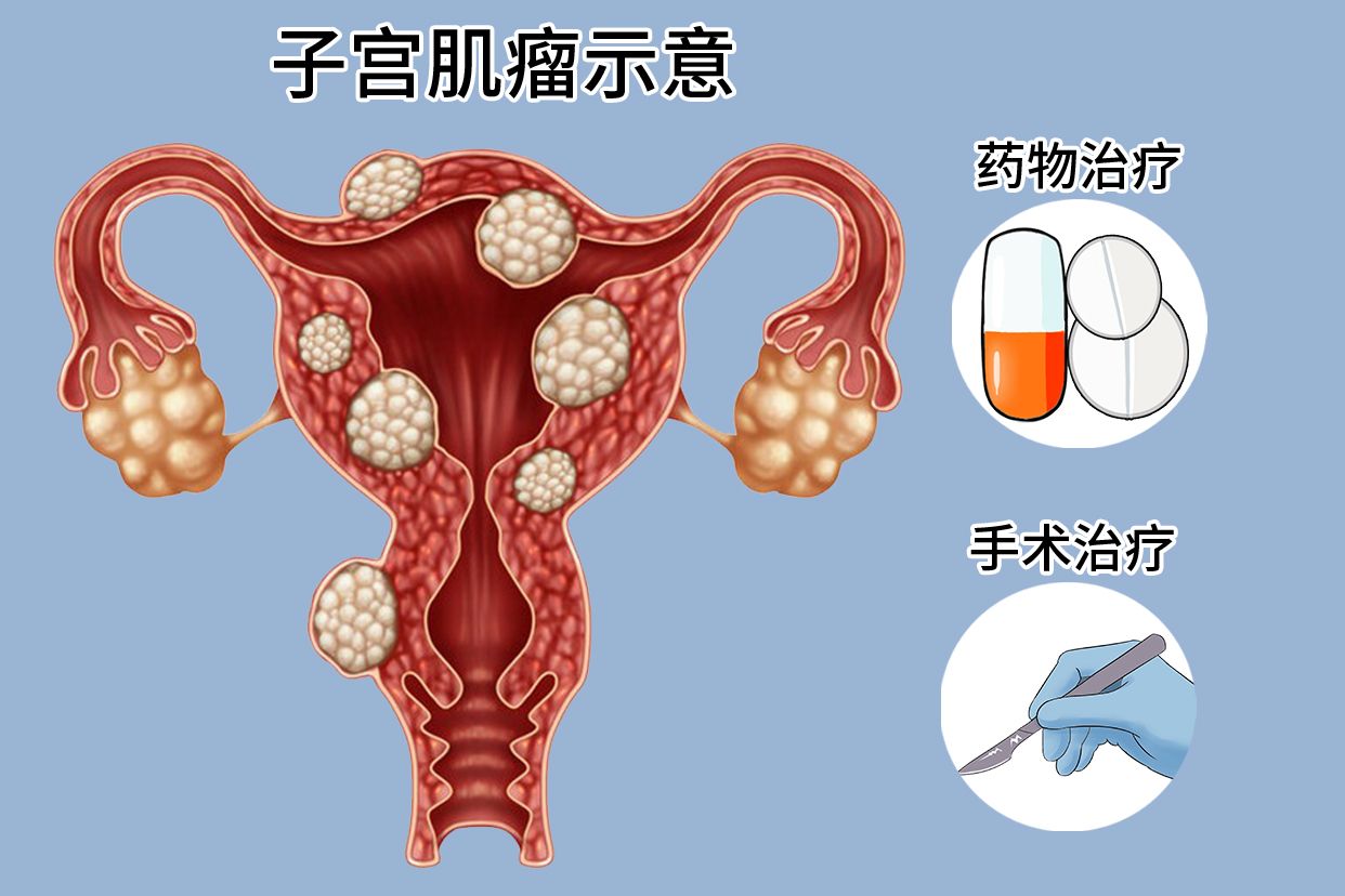 子宫肌瘤最新最有效的治疗方法揭秘