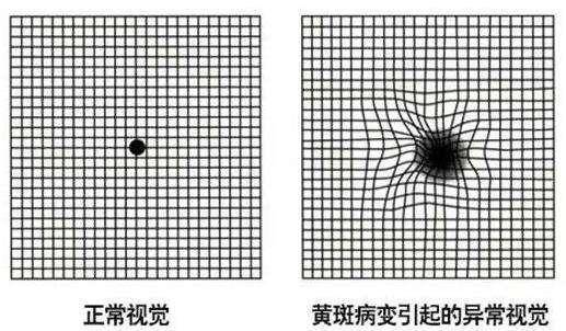 黄斑病变最新特效药治疗，突破与希望之光